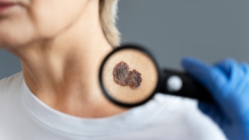 Día Mundial del Melanoma: los últimos avances en los tratamientos de un tipo de tumor que crece en la Argentina
