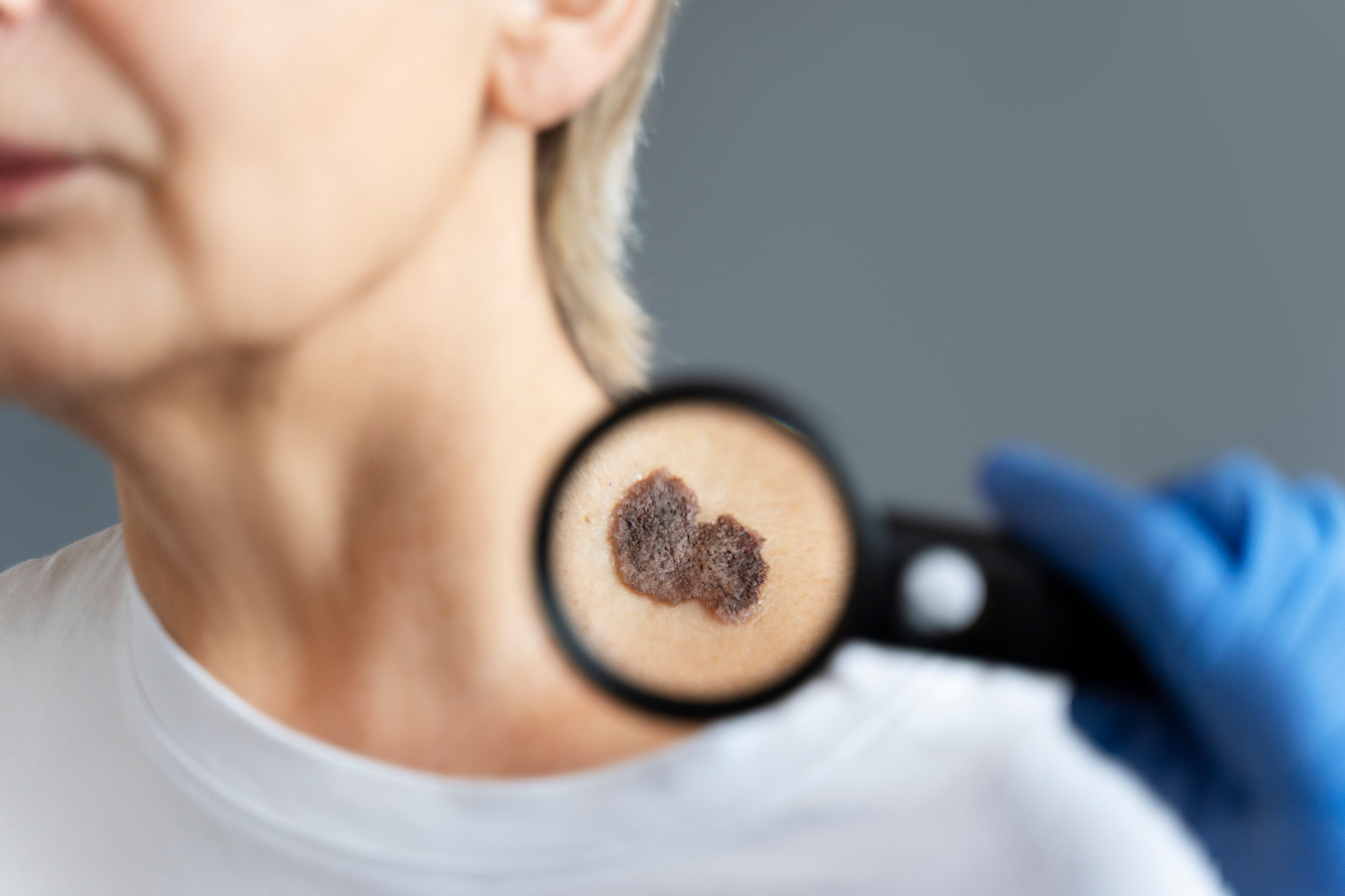 Los diagnósticos de melanoma suelen producirse en etapas avanzadas, dificultando el acceso a tratamientos que podrían salvar vidas