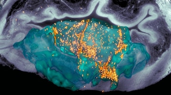 Representación microscópica de un tumor de vejiga de color azul verdoso con puntos brillantes anaranjados que representan nanorobots acumulados sobre él.
