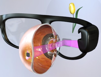 El implante Prima restauró la visión central funcional en el 81 por ciento de los pacientes con degeneración macular relacionada con la edad (Créditos: Stanford University)