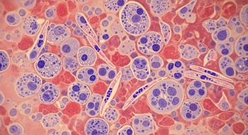 Microfotografía muestra una densa agrupación de células redondas y alargadas, teñidas de púrpura y azul oscuro, sobre un fondo rojizo y rosado claro, revelando detalles celulares.