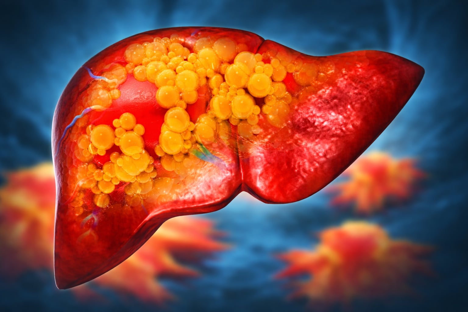 El hígado graso se caracteriza por la acumulación excesiva de lípidos en las células hepáticas (Imagen Ilustrativa Infobae)