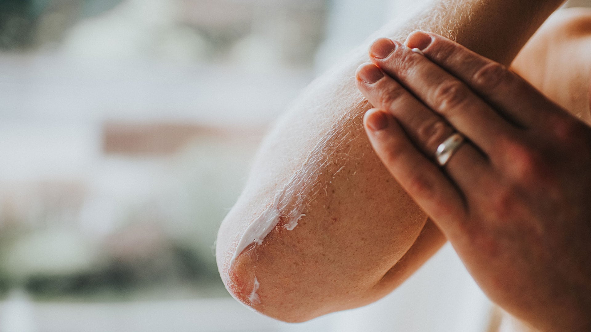La Asociación Estadounidense de Dermatología informó que la epidermólisis bullosa no se contagia y que, salvo la variante adquirida, se relaciona con cambios en los genes