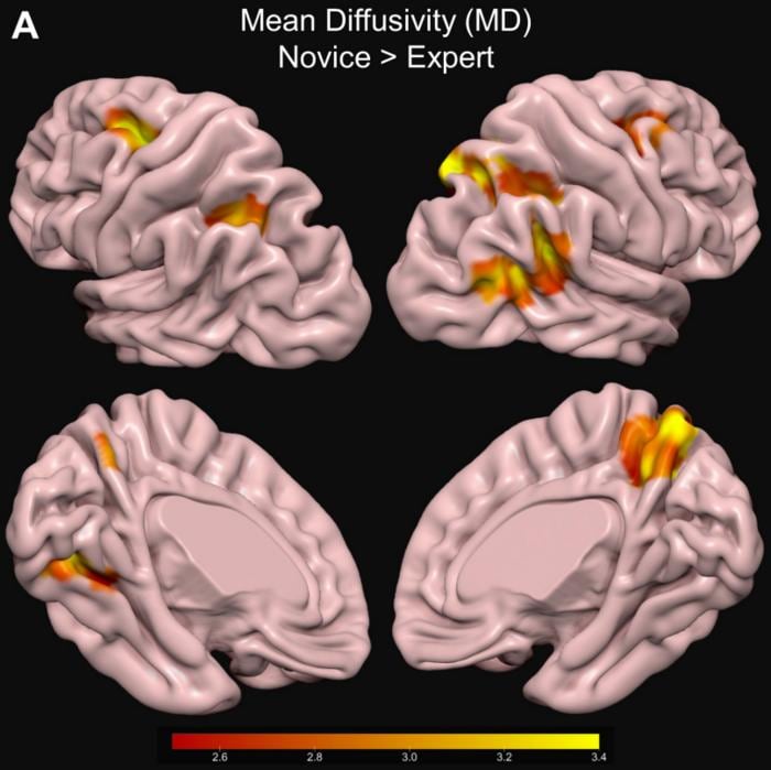 Se muestran las regiones corticales del cerebro con menor difusividad media (DM) en expertos en comparación con principiantes. Una DM más baja implica una estructura cerebral más compacta. La barra de color indica los valores t (Erik
Wing)