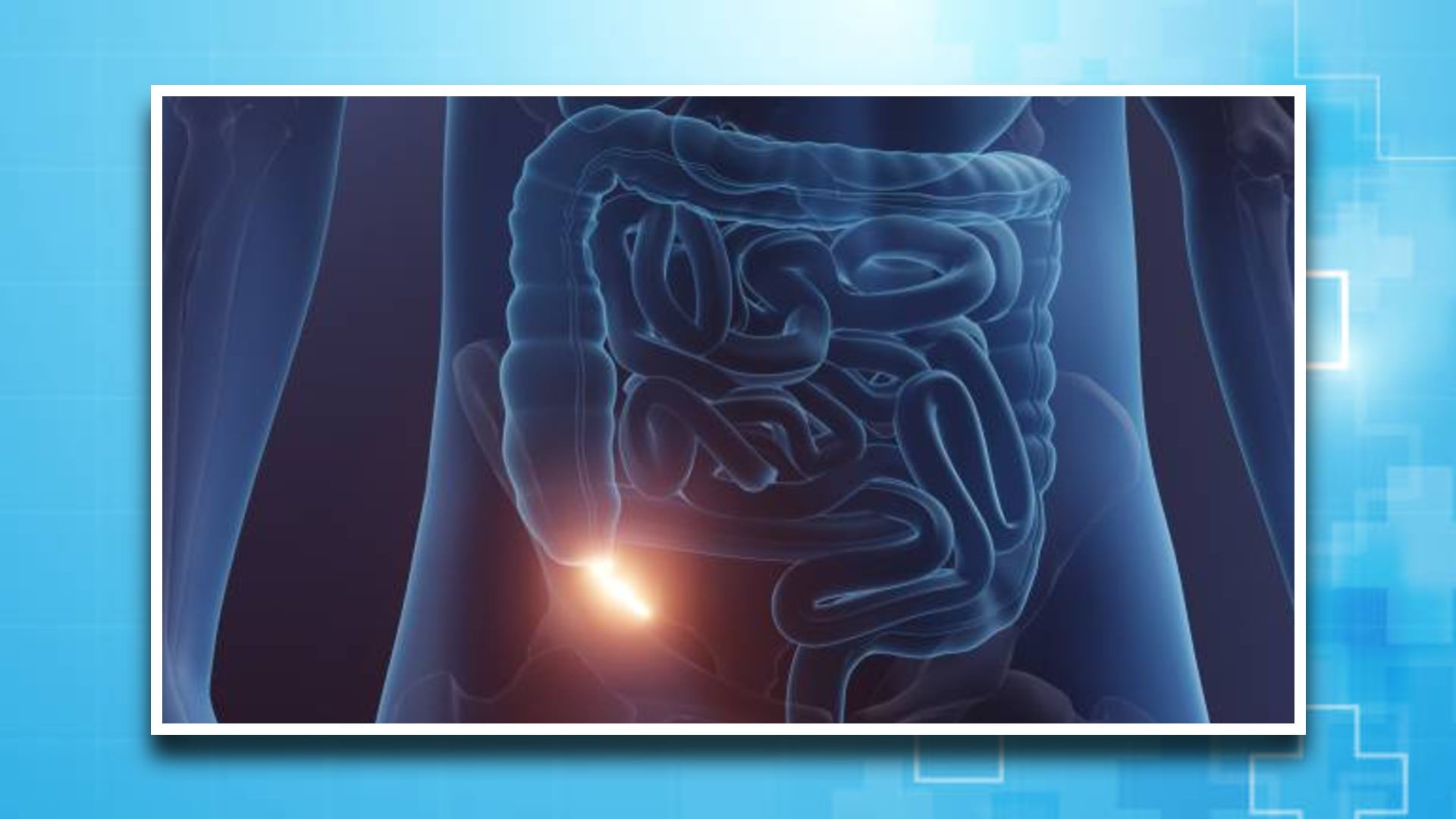 La obstrucción del conducto del apéndice por heces endurecidas infecciones tumores o cuerpos extraños desencadena inflamación presión interna y pus
(Jesús Tovar Sosa/Infobae)