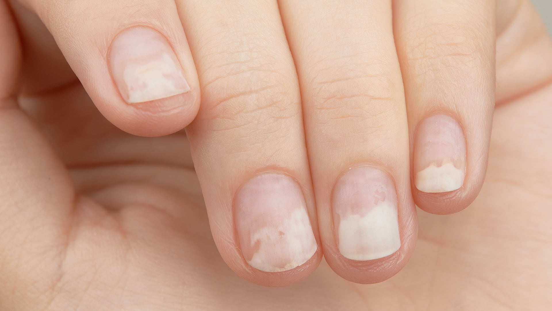 Harvard Health Publishing desmiente la creencia de que las manchas blancas en las uñas están relacionadas con la falta de calcio (Freepik)