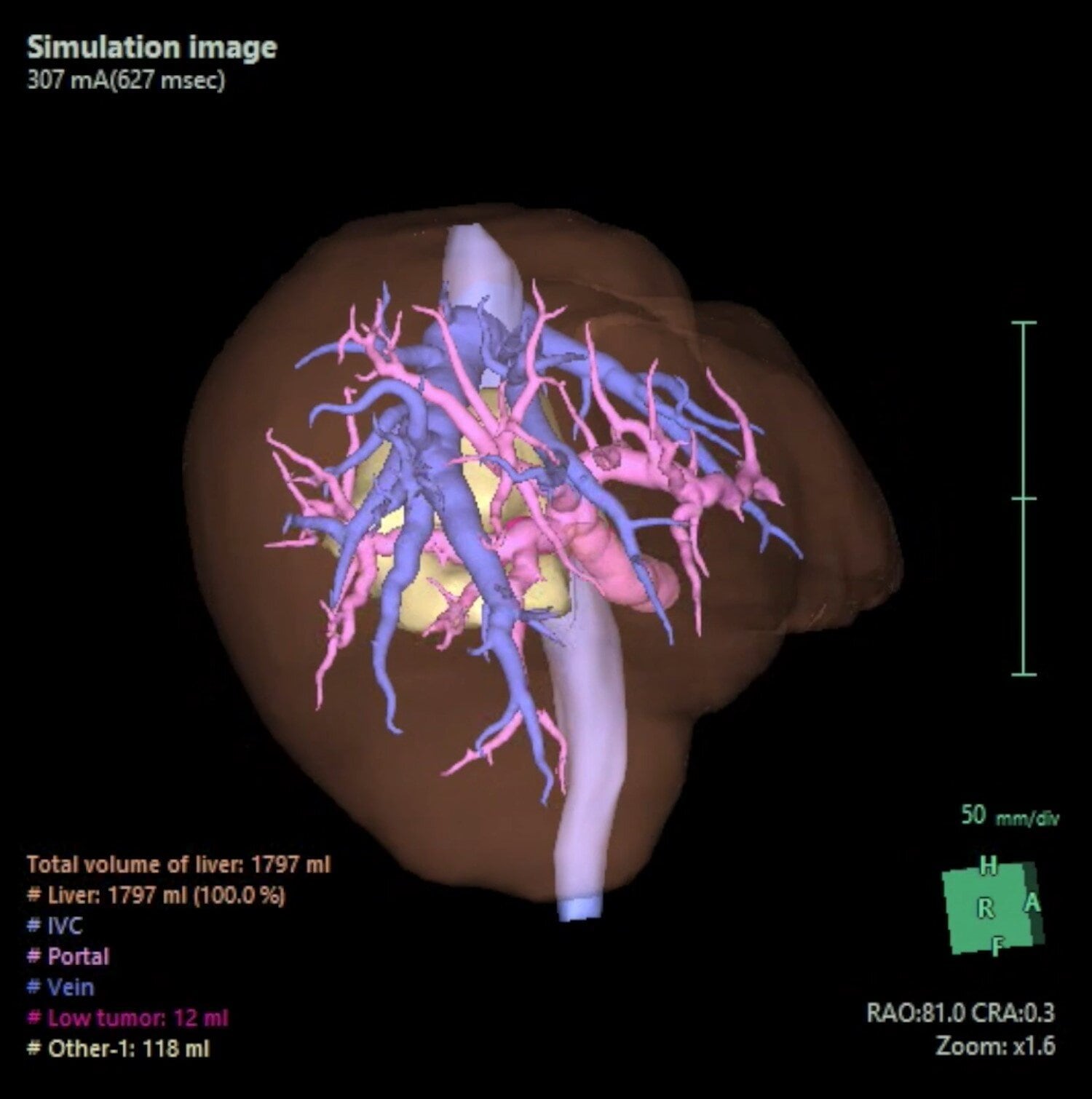 El procedimiento representa un avance en la cirugía mínimamente invasiva para adultos mayores con cáncer hepático Crédito: Annals of Surgical Oncology (2026). DOI: 10.1245/s10434-026-19261-5