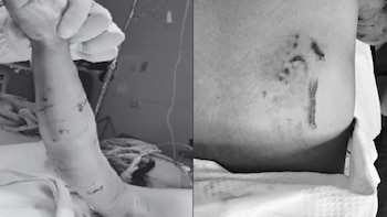 El perro le provocó heridas