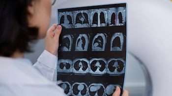 La infección por el virus respiratorio sincitial puede ralentizar la propagación del cáncer de mama a los pulmones