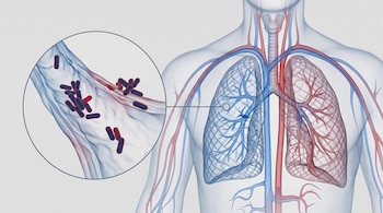 Ilustración del torso humano con los pulmones visibles y un círculo amplificado que expone bacterias con forma de bastón.