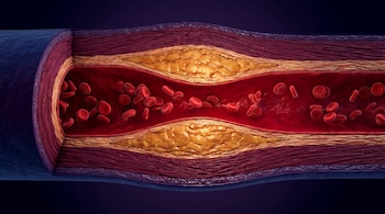 Ilustración tridimensional de una arteria seccionada con depósitos amarillentos en sus capas internas y glóbulos rojos en el canal central.
