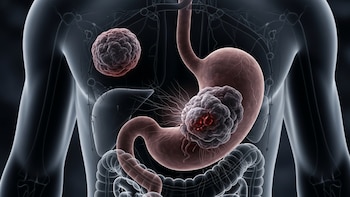 Señales tempranas del cáncer de estómago: los síntomas que médicos piden no pasar por alto