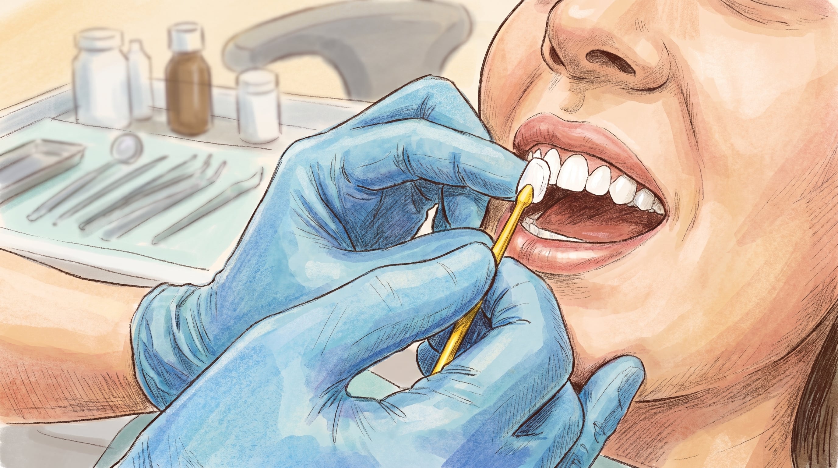 Qué ocurre cuando se deteriora el cemento de las carillas dentales y cómo identificar posibles filtraciones