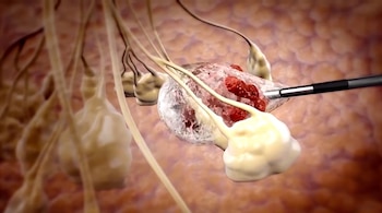 Imagen microscópica de una herramienta médica retirando una masa de tejido irregular y rojizo, rodeada de estructuras celulares beige y marrones.