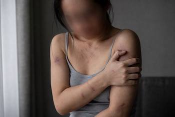 Una mujer con camiseta gris sostiene su brazo con hematomas visibles en la piel y el rostro difuminado.