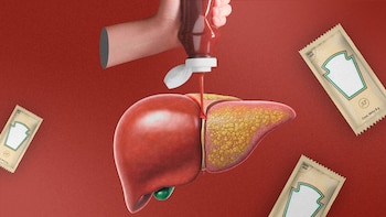 Cuáles son los efectos secundarios de consumir cátsup, mayonesa y aderezos en personas con hígado graso