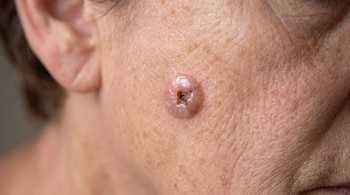 Lesión nodular de color rosado con el centro oscuro y pequeños vasos sanguíneos sobre la piel de un rostro junto a la oreja.