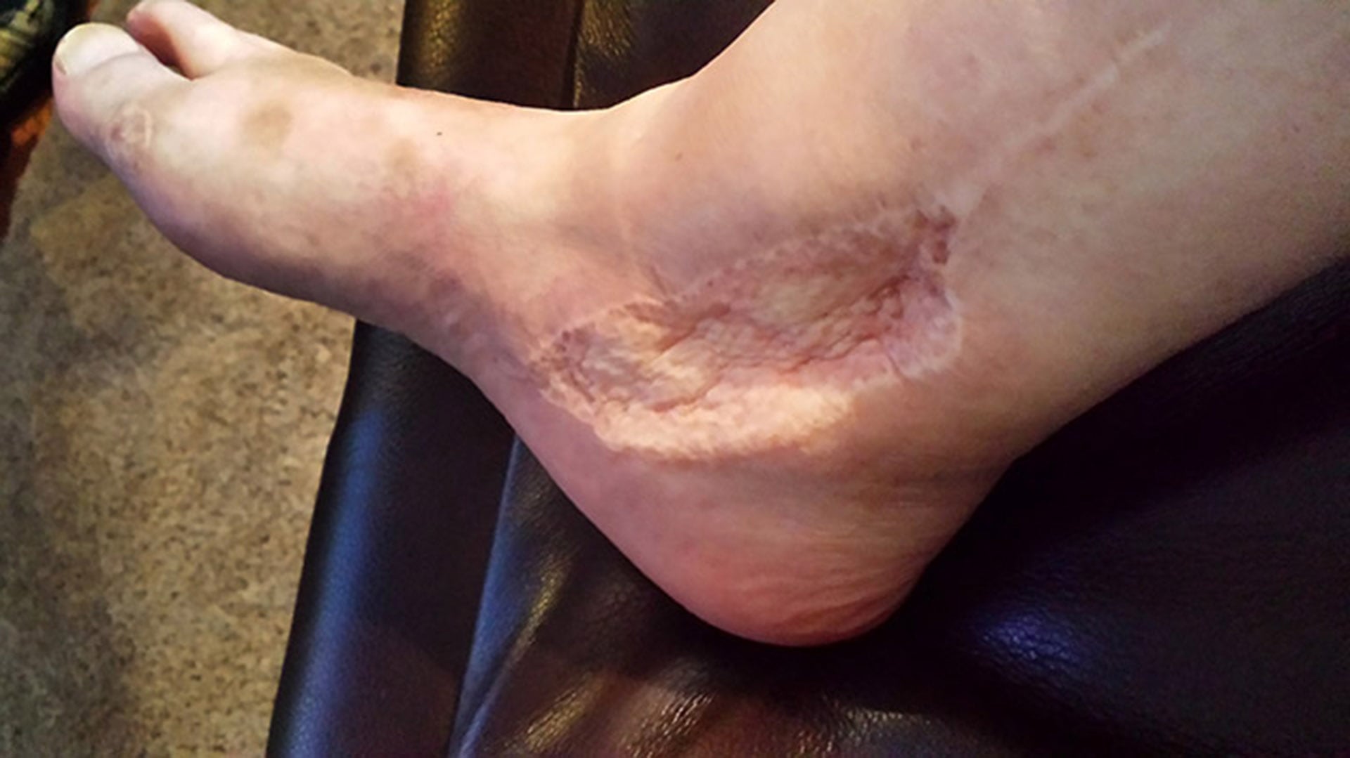 Las infecciones de heridas por Vibrio vulnificus pueden provocar dolor, hinchazón, cambios de color en la piel y descarga de fluidos.