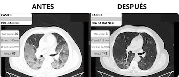 Edema Pulmonar - Doc José Santos