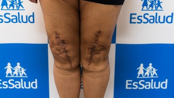 Milagros Álvarez recuperó la capacidad de caminar sin apoyo tras una cirugía reconstructiva que reemplazó tres articulaciones - Créditos: Essalud.