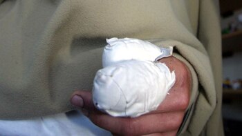 Los casos de lesionados por quemaduras incrementa durante esta temporada (Colprensa)