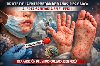 Primer plano de un niño con erupciones en la boca, mano y pie, con un tubo de ensayo que dice "VIRUS COXSACKIE" y personal médico de fondo.