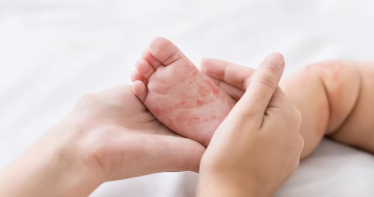 El diagnóstico en un lactante reactiva las alertas sanitarias en una ciudad que no registraba casos de sarampión desde hace varios años (Freepik)