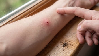 Picaduras de araña doméstica: cómo reconocerlas y cuándo preocuparte