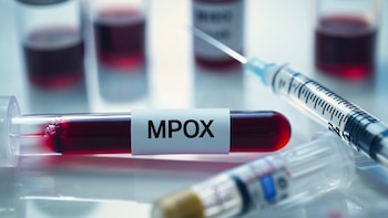 La viruela símica sigue apareciendo