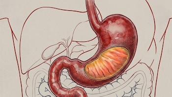 Seis síntomas que podrían alertar sobre un cáncer de estómago en etapas tempranas