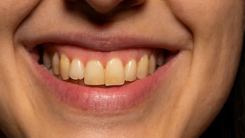 Placa dental: qué es, cómo