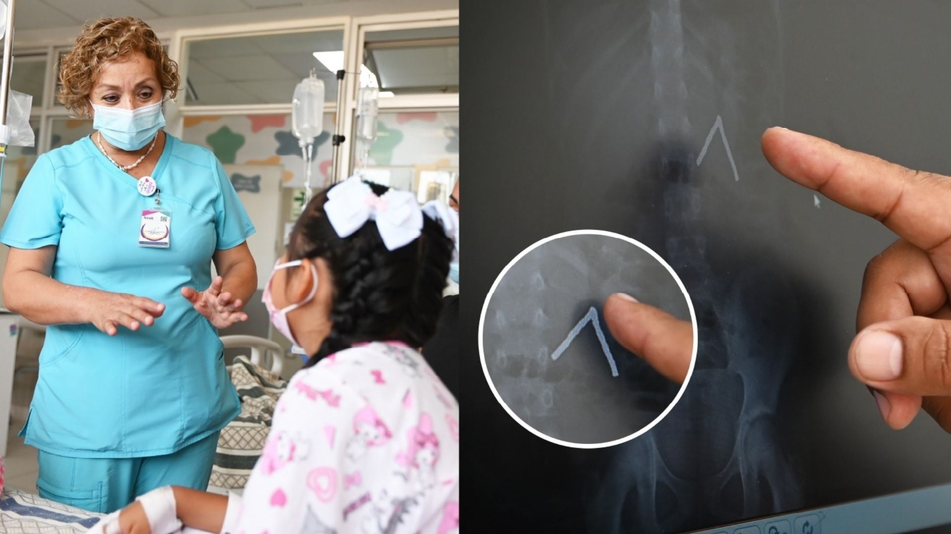 Una niña de nueve años fue atendida de emergencia tras consumir más de veinte piezas magnéticas, lo que le provocó dolor abdominal y perforaciones en el estómago e intestino delgado - Créditos: INSN.
