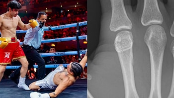 Mario Bautista anuncia fuerte fractura tras pelea con Aarón Mercury donde perdió por nocaut