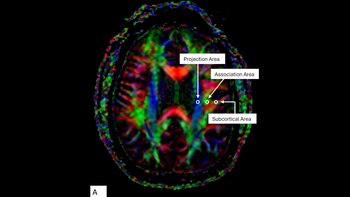 La resonancia magnética DTI-ALPS permitió