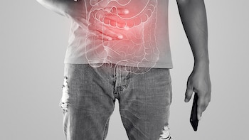 Las tasas de cáncer colorrectal