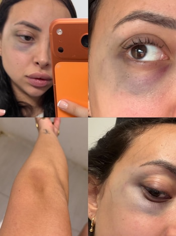 Karen Dinna publicó fotografías con hematomas en el rostro y las piernas como respaldo de sus acusaciones contra el futbolista