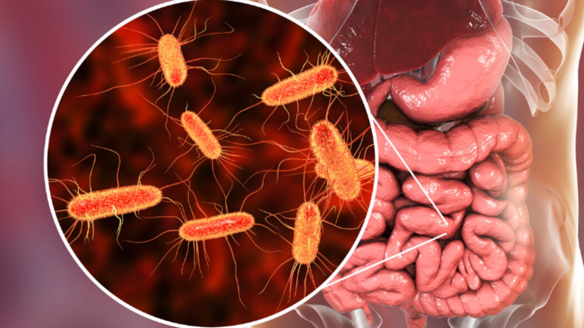 Los síntomas pueden incluir diarrea con sangre o acuosa, fuertes calambres estomacales, vómitos y fiebre (Tecnosoluciones Integrales)
