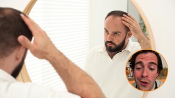 La creatina no provoca alopecia.