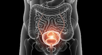 Render 3D translúcido de un torso humano que muestra órganos internos como intestinos, riñones y vejiga, con un tumor iluminado en la vejiga.