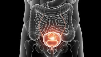 Cáncer de vejiga: síntomas de alarma y factores de riesgo detrás del 70% de los casos
