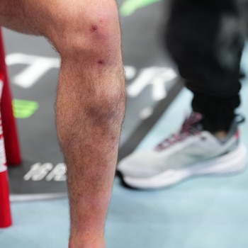 Así quedó la pierna de