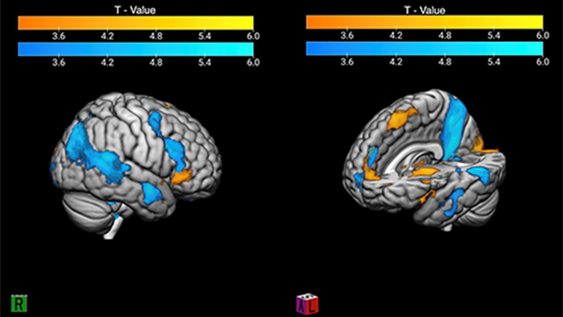 La imagen compara la actividad cerebral de un fanático ante una victoria o una derrota significativa. Los colores cálidos marcan la reacción positiva y los azules muestran cómo el cerebro procesa el dolor de perder racionalizándolo/Radiology