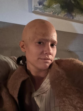 La caracterización de Manuela Viale con efecto calvo mediante maquillaje busca mostrar la transformación física y emocional de su personaje