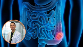 Por qué crecen los diagnósticos de cáncer colorrectal antes de los 40 años: estos son los síntomas de alerta