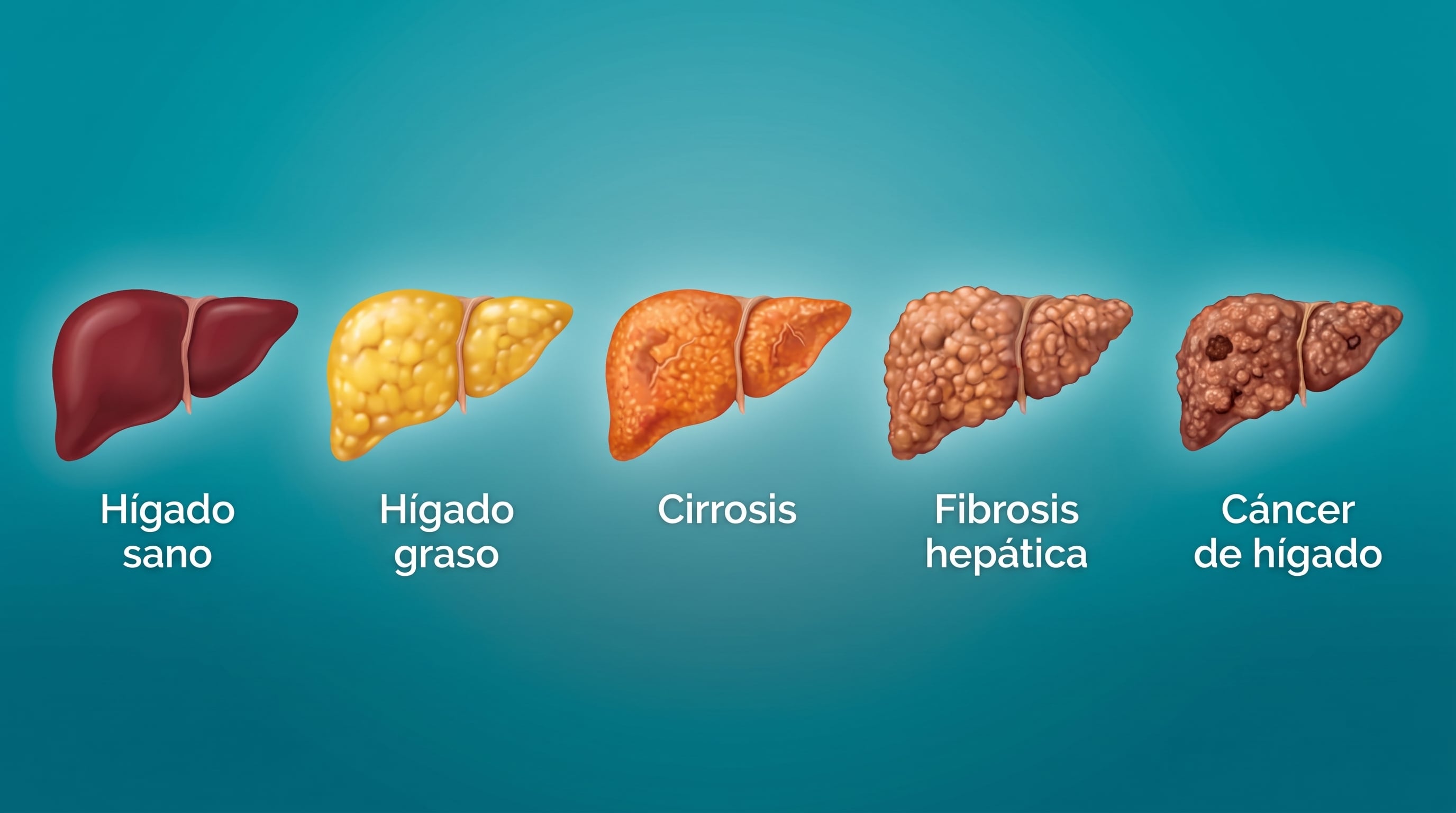 La MASH poligénica quedó vinculada a fibrosis avanzada y falla renal aguda en la forma inflamatoria de la enfermedad hepática (Imagen Ilustrativa Infobae)