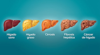 Cinco ilustraciones de hígados con los textos Hígado sano, Hígado graso, Cirrosis, Fibrosis hepática y Cáncer de hígado sobre un fondo azul.