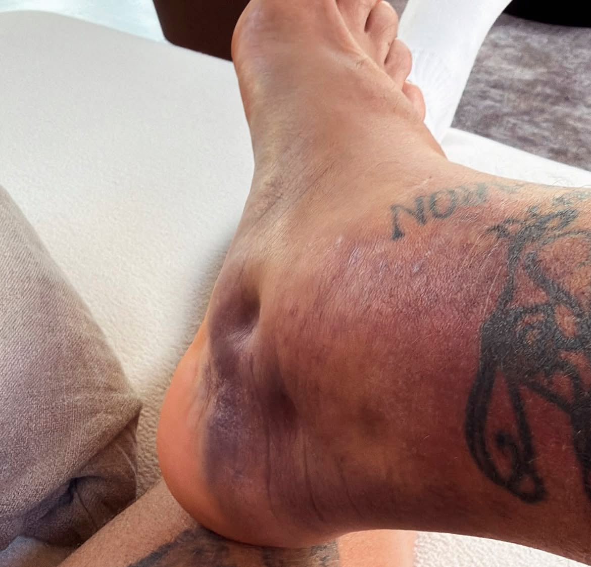 El defensor publicó imágenes del tobillo lesionado con el que encaró la previa del torneo mundialista (@josemariagimenez)