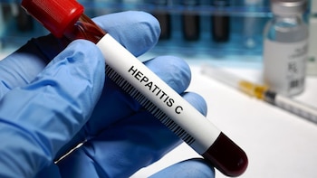 La infección activa de hepatitis C es cuatro veces más prevalente en trastorno mental grave, según SEPSM, SEPD y AEEH