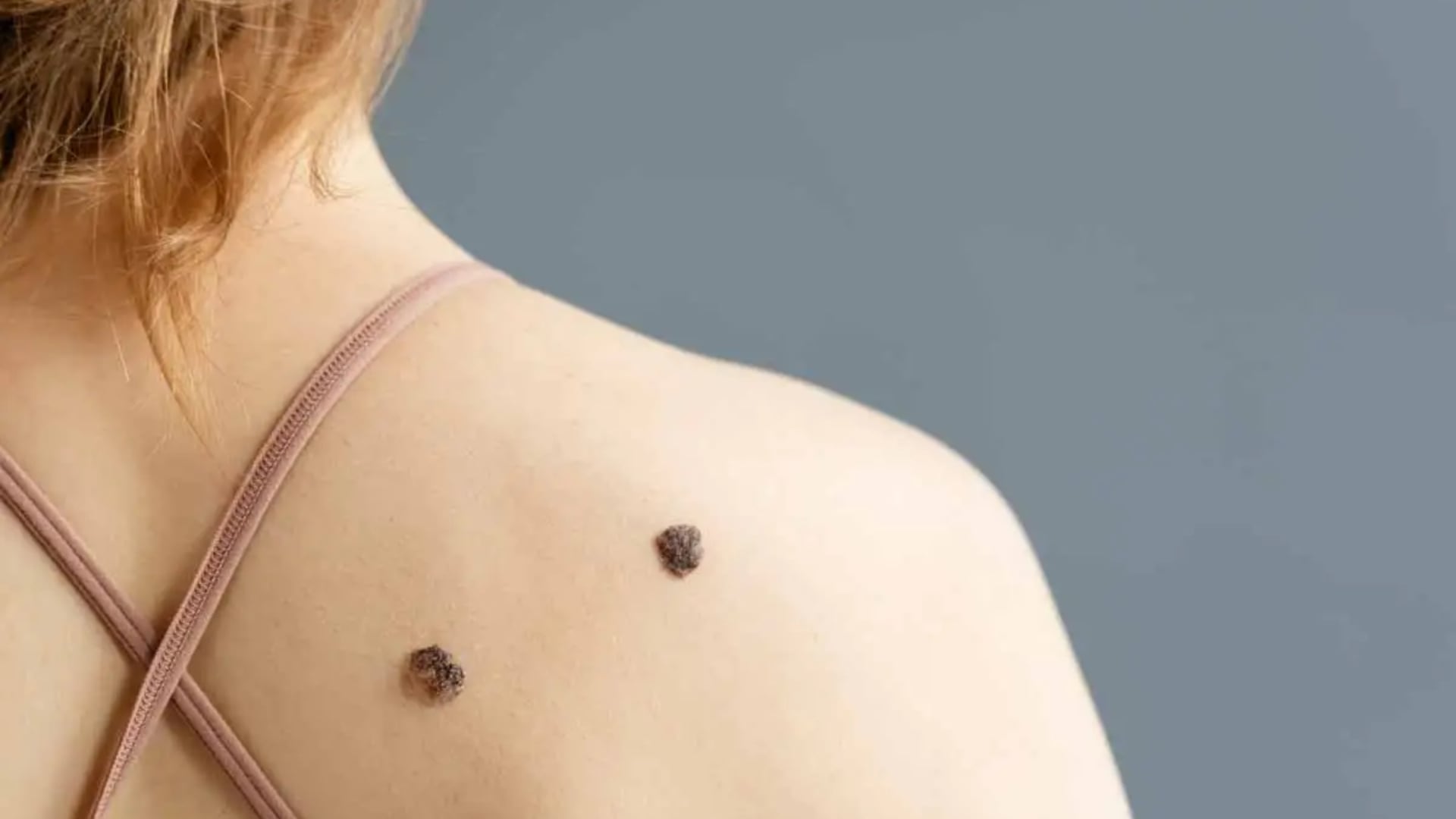 El avance podría reducir la necesidad de biopsias innecesarias durante los controles dermatológicos. (MSD)