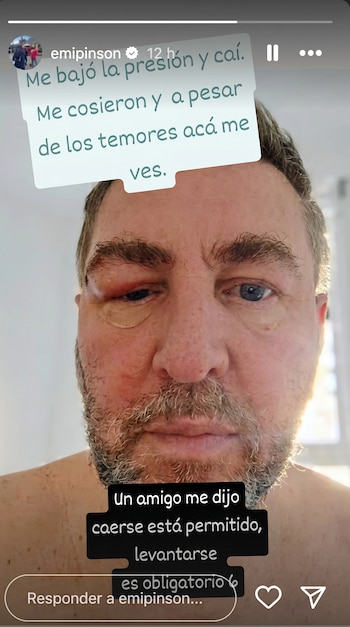 Primer plano del rostro de un hombre con el ojo izquierdo hinchado y morado, con suturas visibles cerca de la ceja, y barba, mirando directamente a cámara.